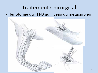 ténotomie
